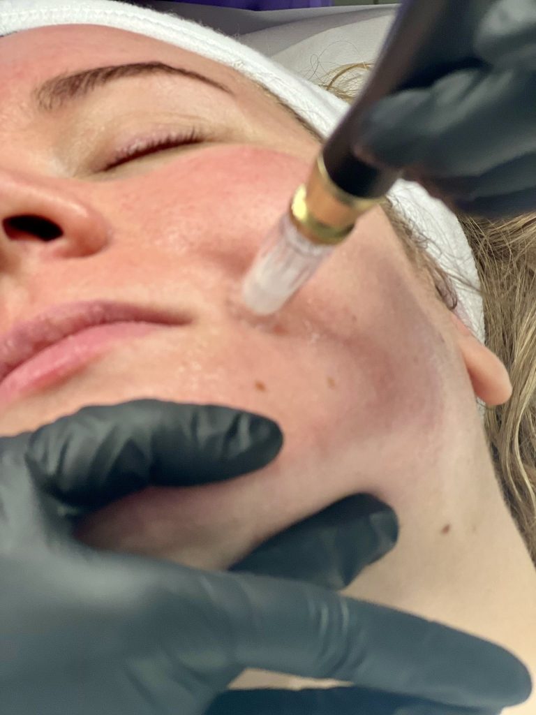 Medical microneedling treatment being performed on the face to stimulate collagen and improve skin texture.