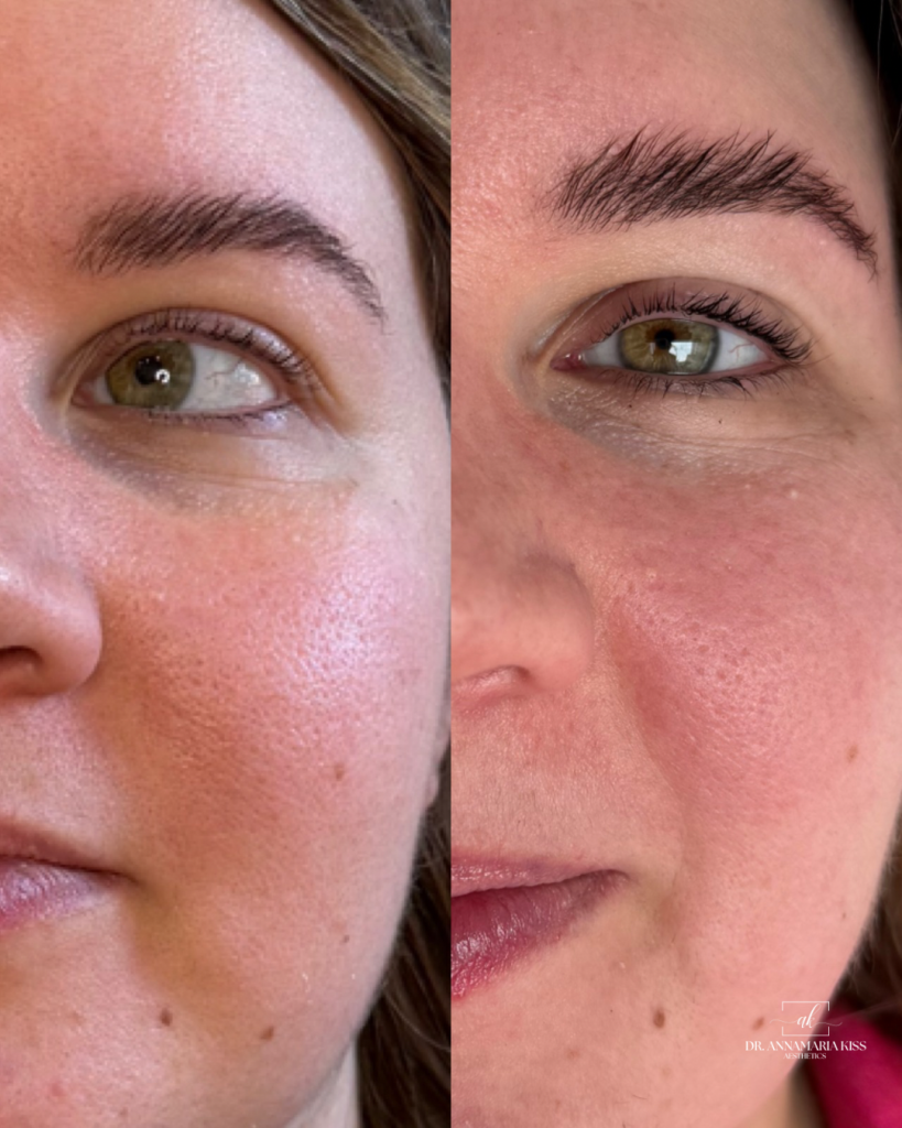 enlarged-pores-microneedling-dr-annamaria-kiss Smoother, more radiant skin with improved skin texture.