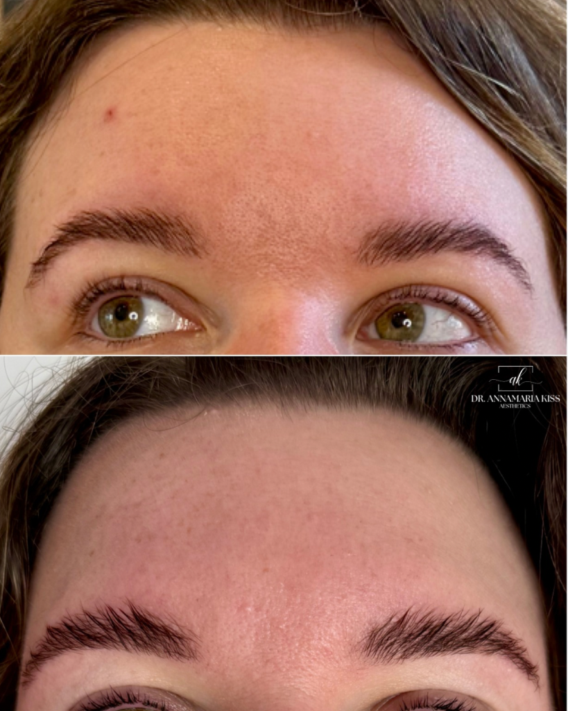 Improved skin texture and appearance of pores.